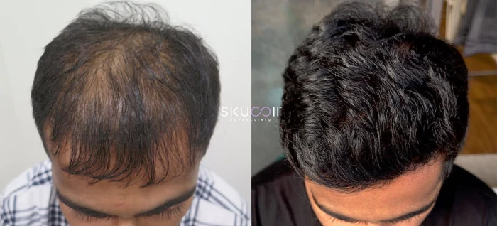 Before and After Hair Transplant Pics 1
