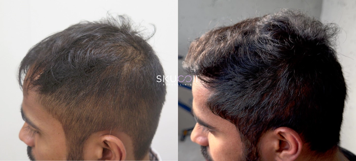 Before and After Hair Transplant Pics 2
