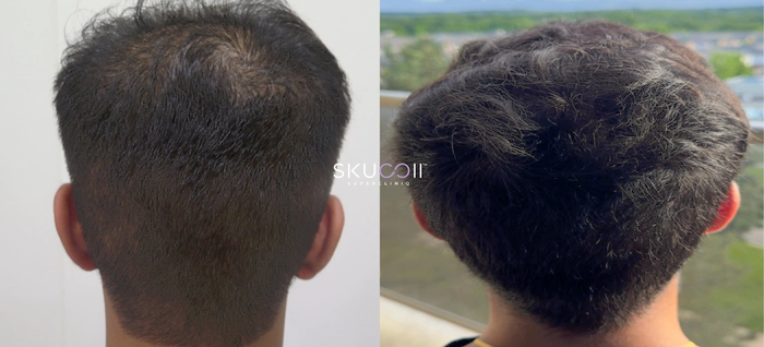 Before and After Hair Transplant Pics 3