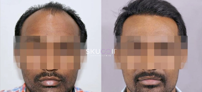 Before and After Hair Transplant Pics 4