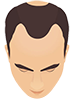 Baldness Stages 2