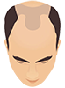 Baldness Stages 3