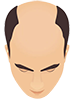 Baldness Stages 4