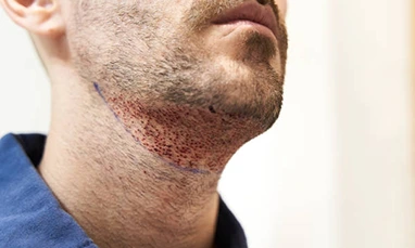 Beard Hair Transplant
