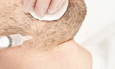 Body Hair Transplant