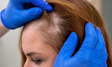 Hair Exosomes
