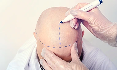 Mega Hair Transplant