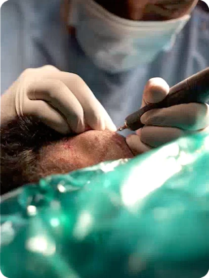 Hair Transplant Process Video Image